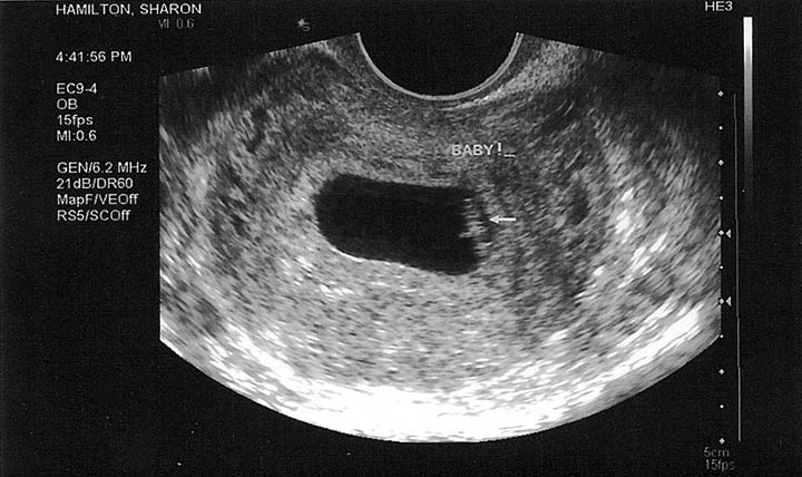 Gebelikte 5. Haftada bebeğin ultrason görüntüsü nasıldır?