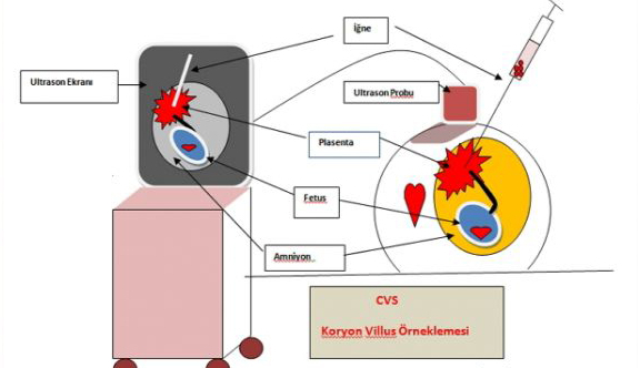 CVS (Koryonvillus Biyopsisi) Nedir?
