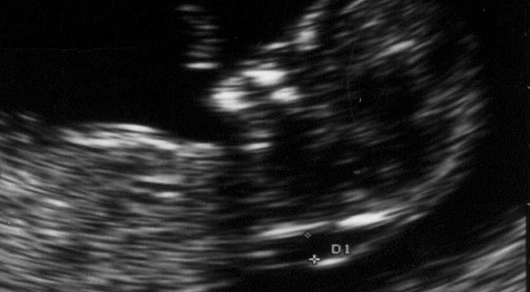 Ense Kalınlığı Ölçümü Nedir?