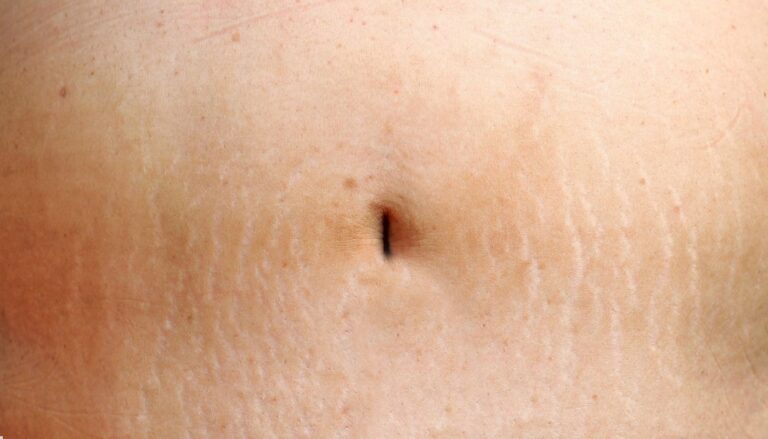 Gebelikte Karında Çatlaklar Engellenebilir mi?